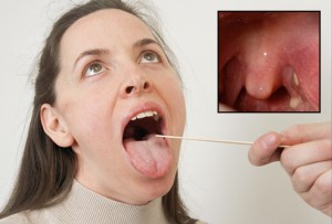 tonsil-stones-1 tonsil-stones-1